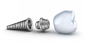 Dental Implants in Stapleton, CO